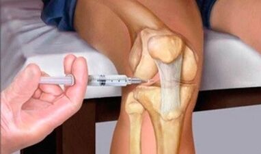 Acid hialuronic cu artroza articulației genunchiului