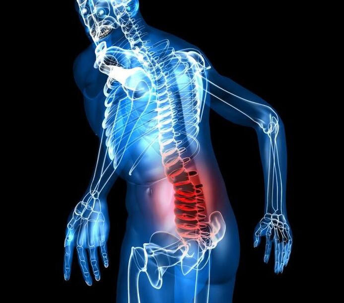 Etape de grad și dezvoltare ale osteochondrozei lombare