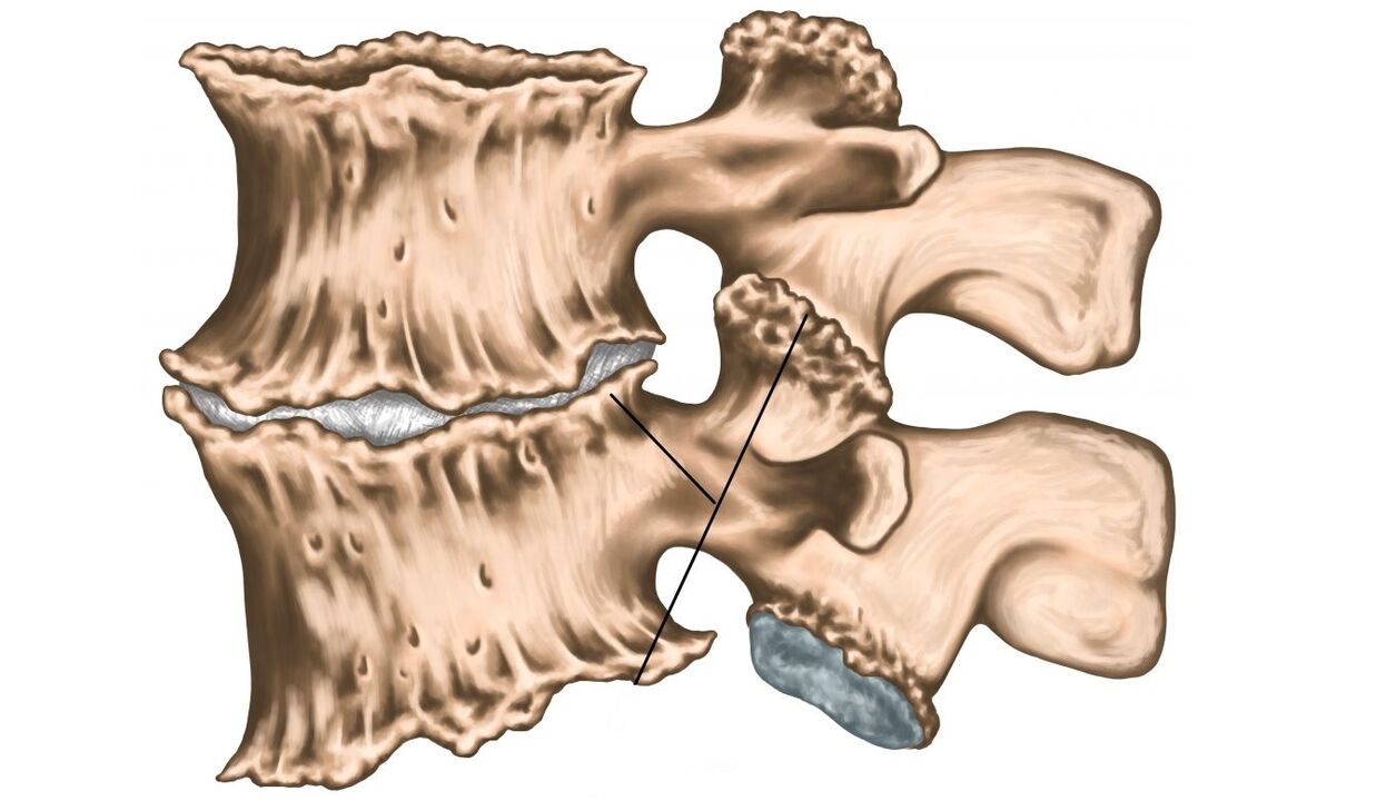 leziuni ale coloanei vertebrale datorate osteocondrozei