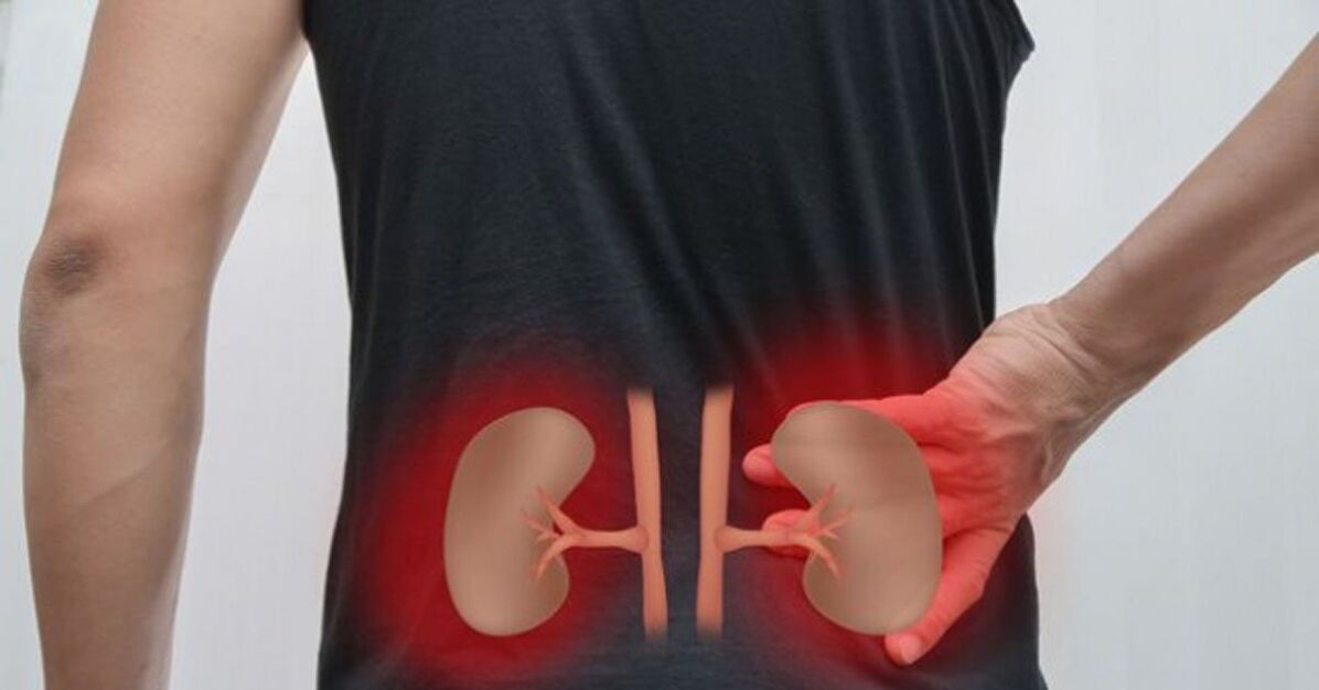 Inflamația rinichilor poate provoca dureri de spate