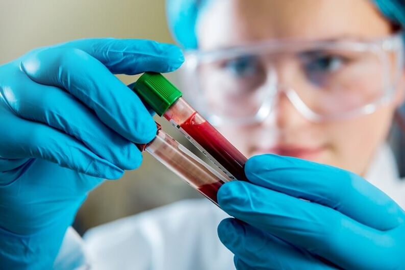 Test de sânge complet pentru a diagnostica durerea lombară