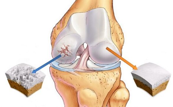 Osteoartrita articulației genunchiului (stânga) și cartilajului normal (dreapta)
