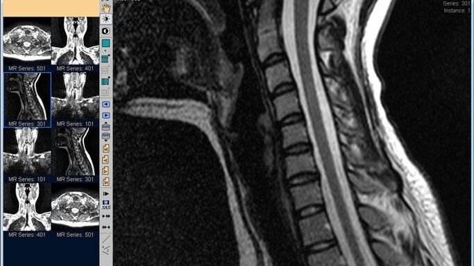RMN-ul coloanei cervicale este cea mai bună metodă de diagnosticare a durerii de gât